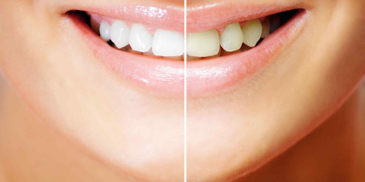 How whitening strips can damage your teeth